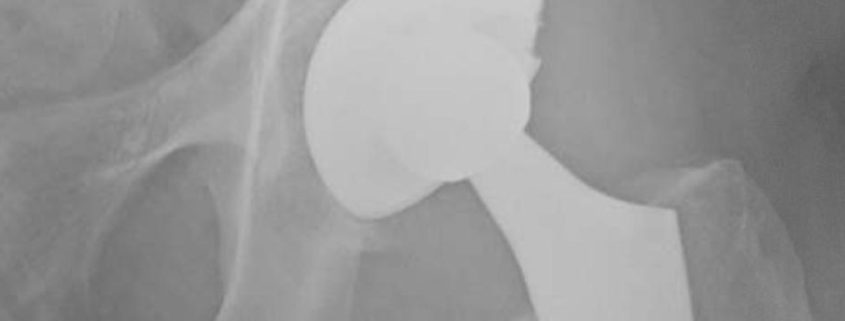 superior-hip-replacement