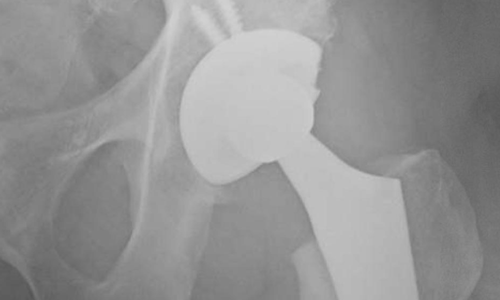 Superpath Or Superior Approach To The Hip In Total Hip Replacement