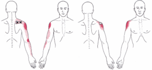 Trapezius pain radiating down arm deals