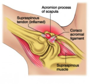 rotator pain 3