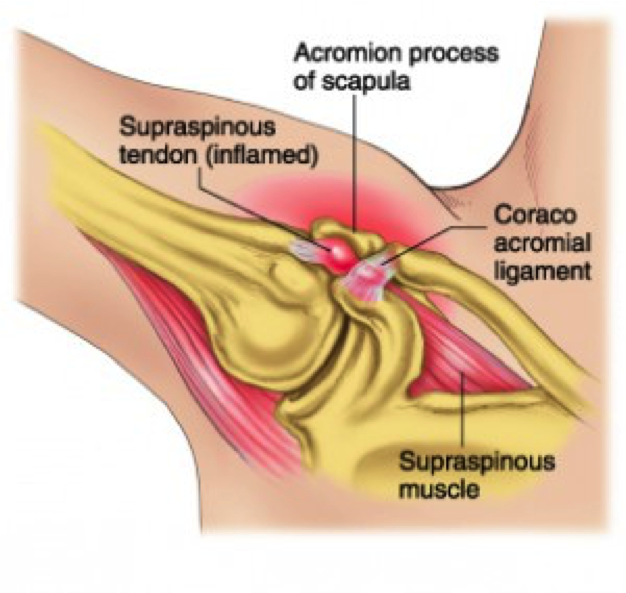 rotator pain 3