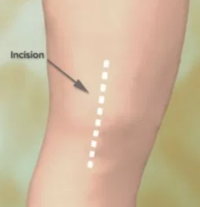 Incision Knee