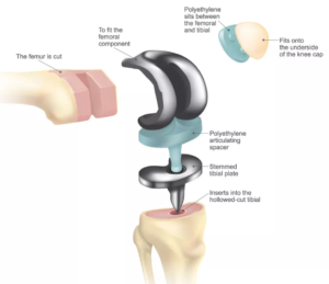 Total Knee Replacement implant parts