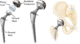 hip replacement graphic