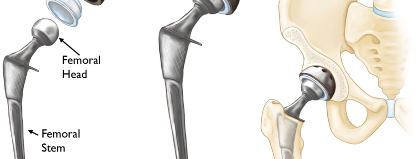 hip replacement graphic