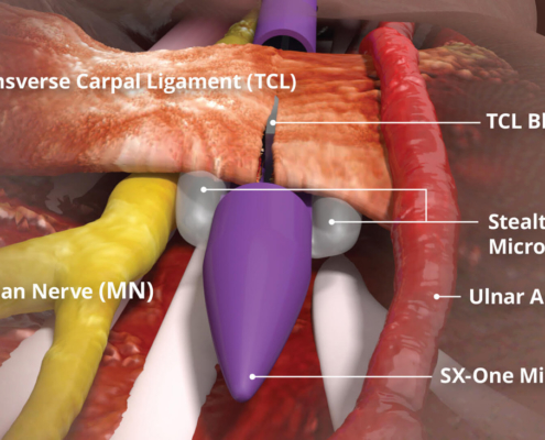 carpal tunnel surgery austin tx