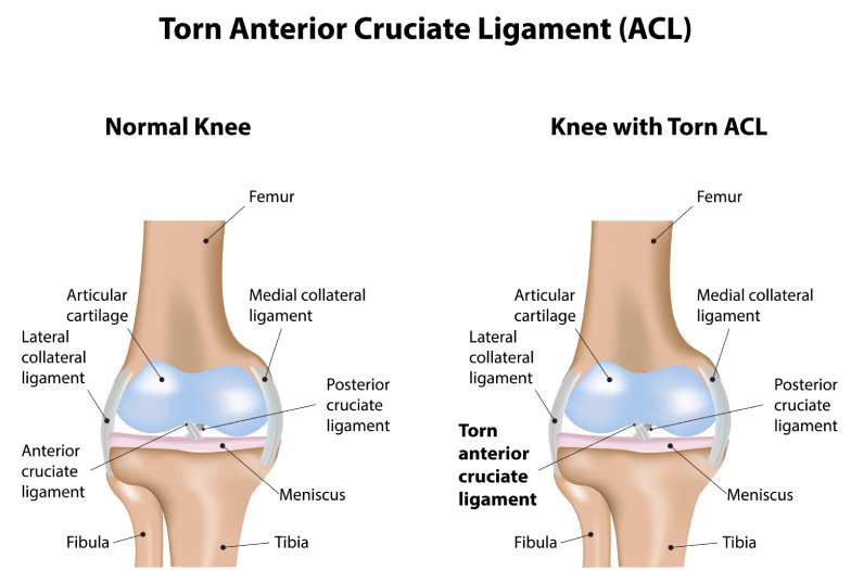 acl reconstruction(1)