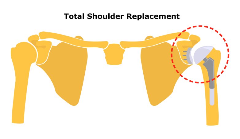 austin shoulder replacement